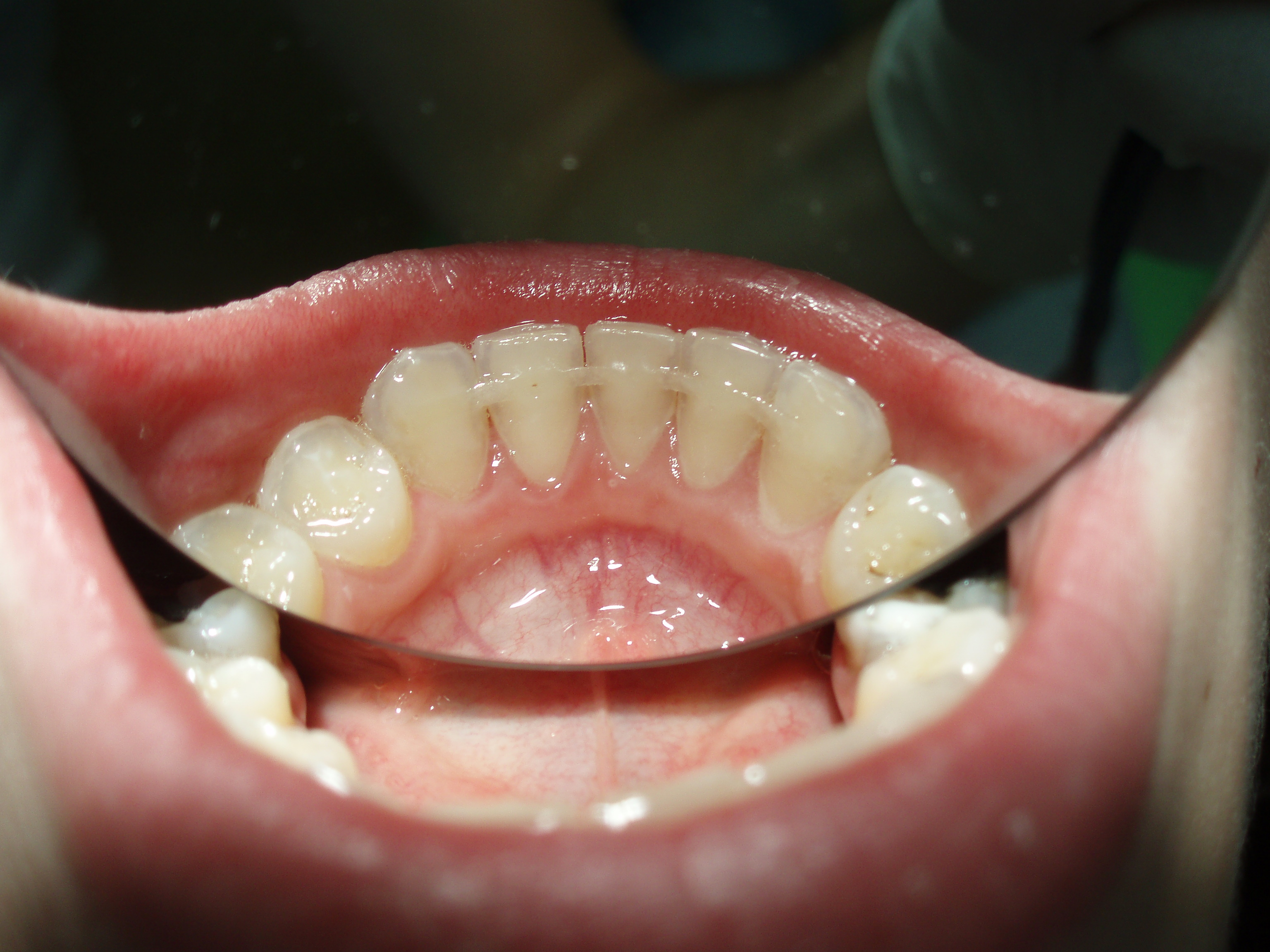 1. Post-orthodontic retainer; Courtesy of Dr. Fillipi, Czech Republic