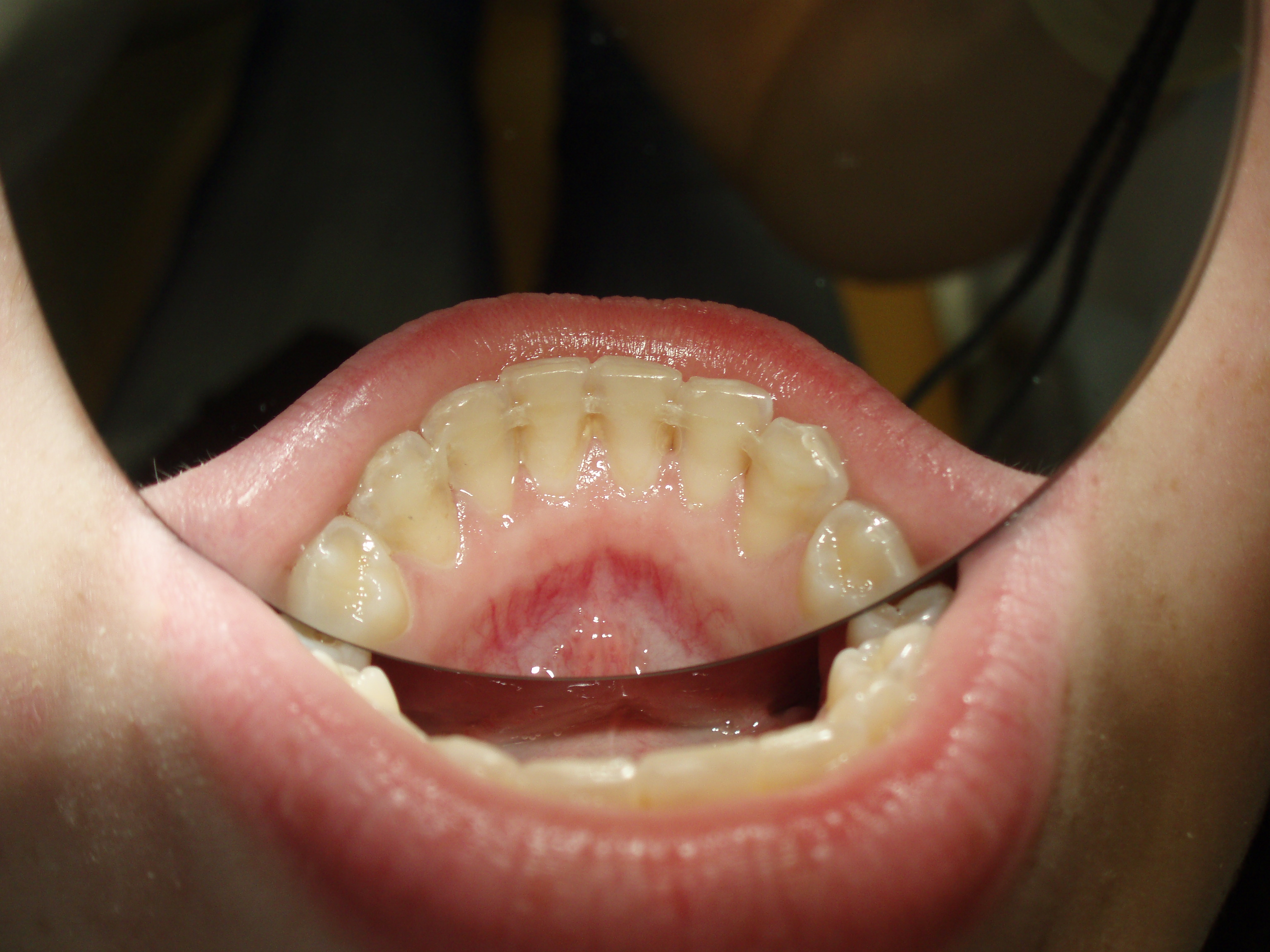 3. Post-orthodontic retainer; Courtesy of Dr. Fillipi, Czech Republic