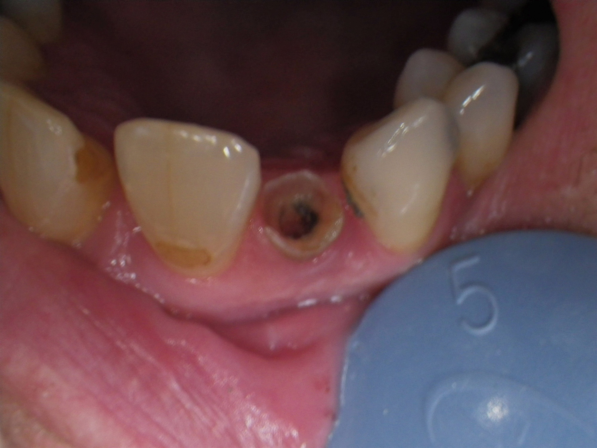 1. Endodonticky ošetřený zub; se svolením Dr. Nelsona, USA