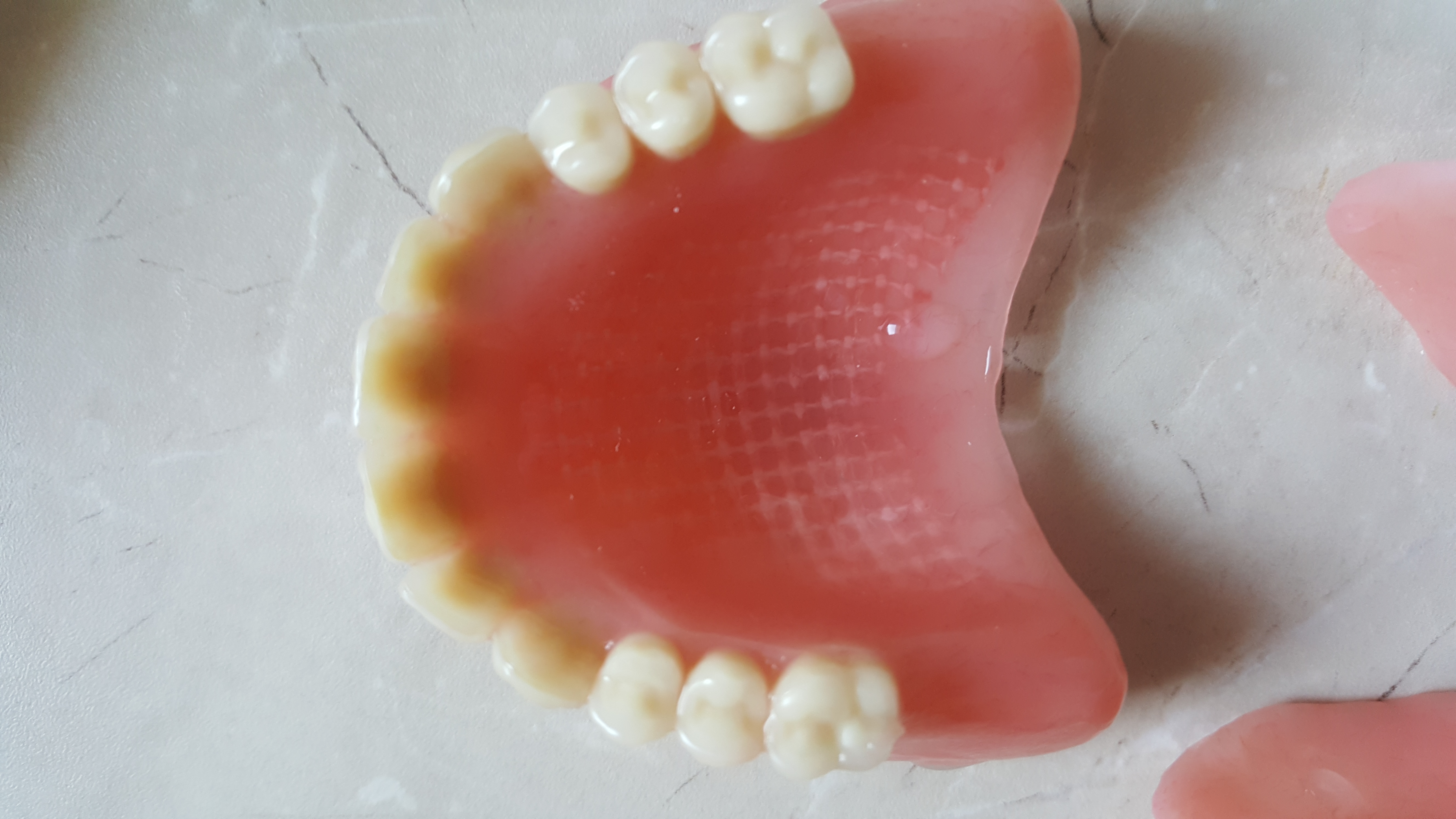 3. Vyztužená zubní náhrada; se svolením Simona Langrana, Irsko