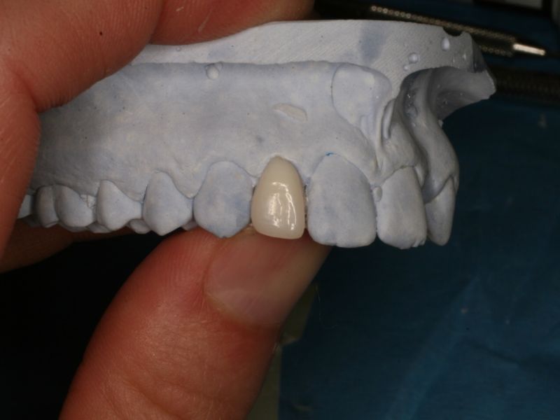 2. Můstek na modelu; se svolením Dr. Kravera, USA