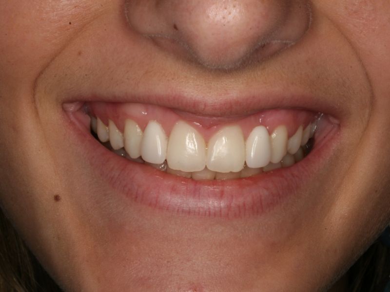 3. Výsledný můstek; se svolením Dr. Kravera, USA