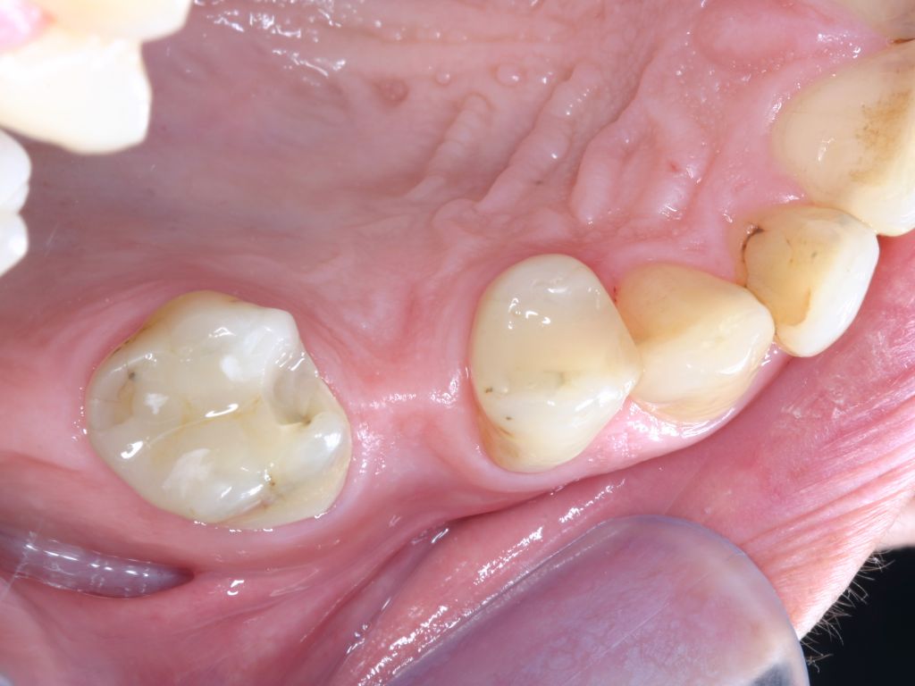 Dentapreg - Posterior Bridge